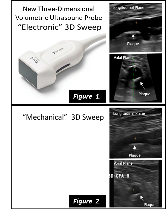 “New 3-Dimensional Volumetric Ultrasound Method for Accurate Quantification of Atherosclerotic”; B. López-Melgara, V. Massa et al. ; JACC Cardiovascular Imaging