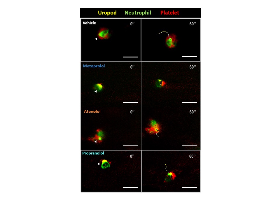 La figura muestra imágenes de microscopía intravital bidimensional del músculo cremáster inflamado de un ratón, en las que se observa la movilidad del neutrófilo (en verde), así como su interacción con las plaquetas (en rojo), en función del tratamiento recibido, ya sea vehículo (salino) o uno de los distintos beta-bloqueantes bajo estudio: metoprolol, atenolol o propranolol. Las flechas indican las interacciones neutrófilo-plaqueta en el dominio del urópodo (amarillo) y las líneas discontinuas el desplazamiento del neutrófilo en 60s