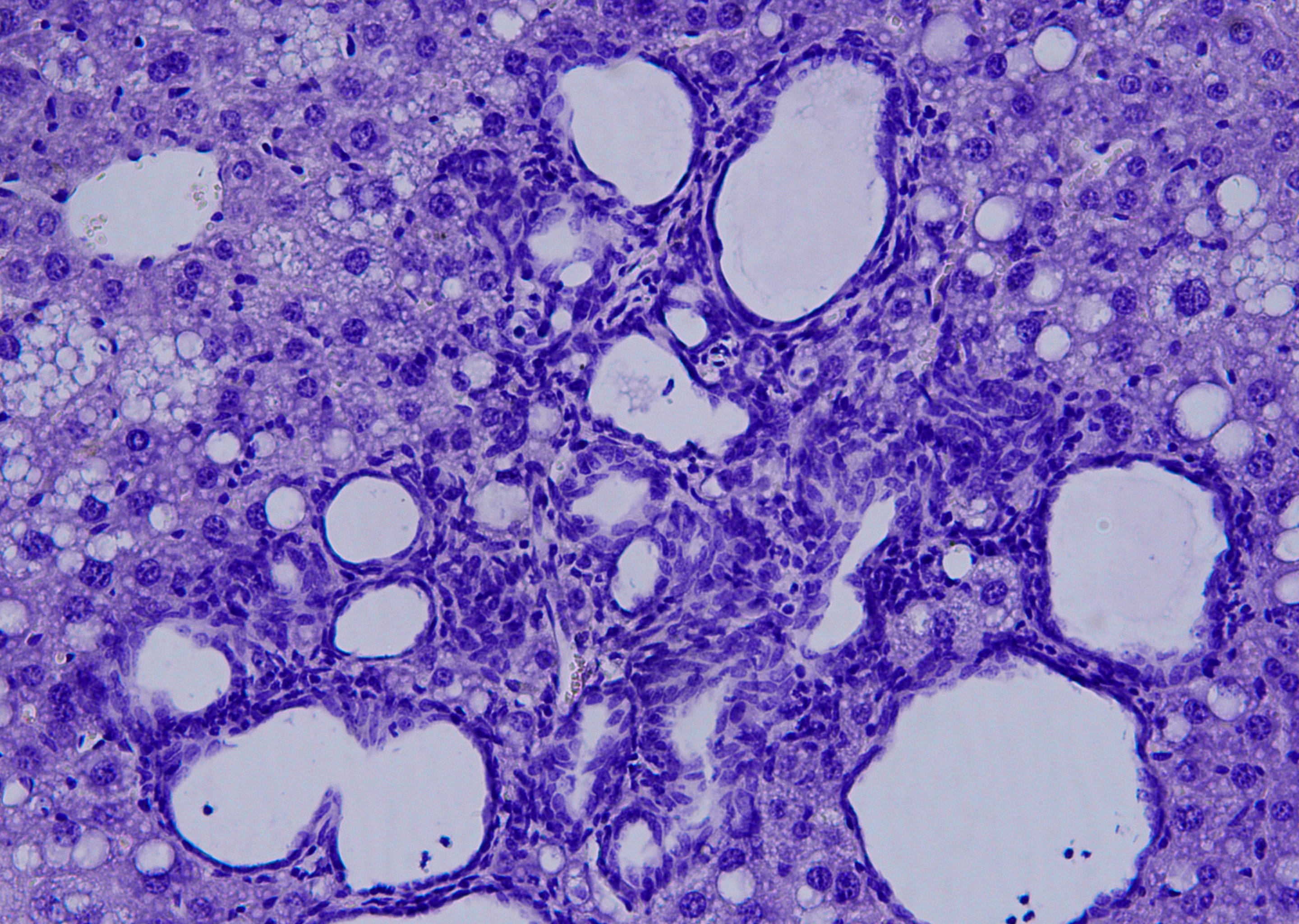 Colangiocarcinoma visto al microscopio