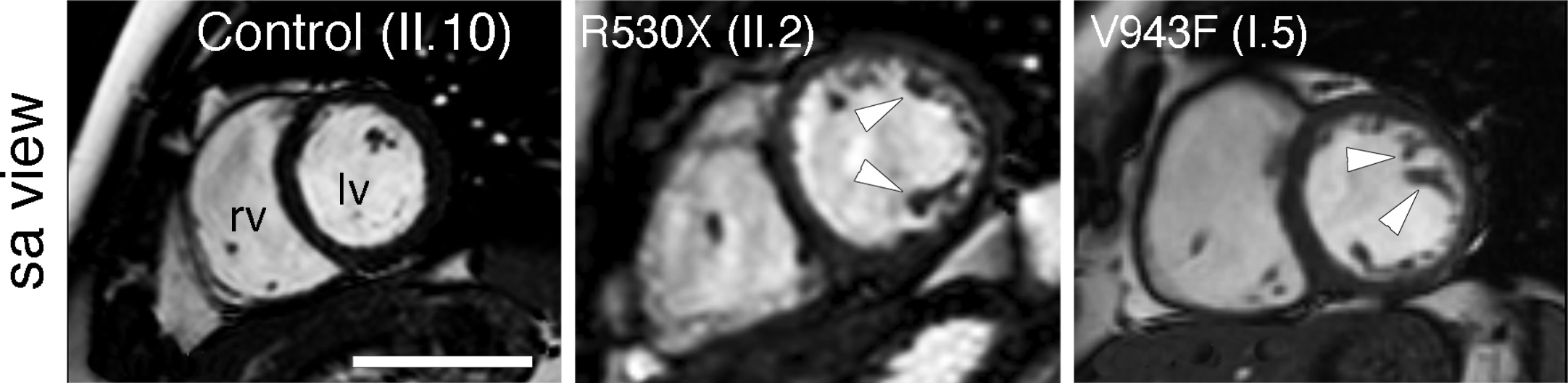 Distintos genes modificadores determinan el efecto de dos mutaciones causantes de miocardiopatía