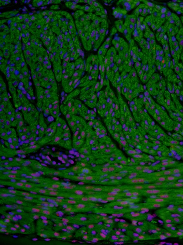 SRSF3 expression in adult cardiomyocytes. Pink staining shows SRSF3 expression in cell nuclei, which are stained blue. Green staining shows the presence of troponin, a sarcomere protein expressed in cardiomyocytes. 