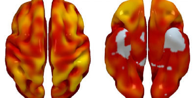 3D reconstructions of superior (left) and inferior (right) brain regions, showing regions with lower metabolism associated with the presence of atherosclerotic plaques in the carotid arteries. The color code indicates the magnitude of the observation (yellow, strong association; red, lower association). Gray indicates areas showing no association with carotid plaque presence