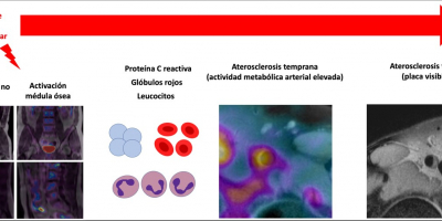 Bone marrow contributes to the development of atherosclerosis