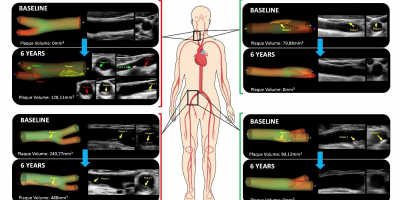 Casos de progresión de aterosclerosis (izquierda) y de regresión (desaparición de la misma, derecha)  en arterias carótidas (en el cuello) en las femorales (ingles). En cada caso se muestra el estudio basal (en la inclusión del participante, baseline) y el estudio 6 años después de la misma arteria. En cada caso, las imágenes de la derecha son las directamente obtenidas por el ecógrafo vascular, y a la izquierda la reconstrucción tridimensional.