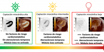 Los factores de riesgo cardiometabólico y la aterosclerosis temprana se asocian a un menor consumo de glucosa por el corazón