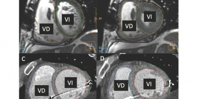 La figura muestra imágenes mediante resonancia magnética cardíaca (A y B) y tomografía computarizada (C y D) de un corazón en diástole (A y C) y sístole (B y D) para el cálculo de la función de ambos ventrículos. VD: Ventrículo derecho; VI: Ventrículo izquierdo. 
