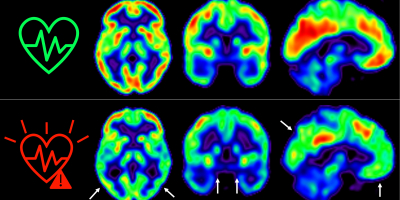 Las imágenes representan la captación de glucosa en cerebro medida por tomografía por emisión de positrones en individuos de mediana edad con bajo (arriba) o alto (abajo) riesgo cardiovascular sostenido a lo largo de 5 años. Los colores representan el consumo de glucosa cerebral, con rojo indicando un consumo más alto y azul más bajo