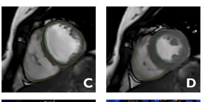 Imágenes del corazón obtenidas mediante resonancia magnética en las que se analizan distintas estructuras de la anatomía y función del corazón: aurículas (paneles A y B), ventrículos (paneles C y D), características del tejido cardiaco (paneles E y F).