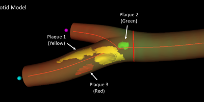 Modelo 3D de la arteria femoral derecha que se obtiene con la imagen 3D real donde se representa la localización, número y extensión de las distintas placas de aterosclerosis, hasta 3 placas en el caso de este paciente (flechas), distribuidas a lo largo de la bifurcación femoral y su rama superficial
