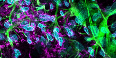 Imagen obtenida por microscopía confocal en la que se observa el borde de la cicatriz glial producida tras el infarto cerebral, lo cual dificulta la posterior regeneración de la zona. Este evento es atenuado en gran medida a través del tratamiento con metoprolol intravenoso pre-reperfusión. 