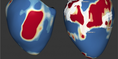 Resonancia magnética de dos pacientes con miocardiopatía dilatada. A la izquierda, paciente con fibrosis sin canales de conducción y a la derecha, paciente con múltiples canales.
