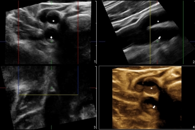 3D ultrasound of the right femoral artery. An atherosclerotic plaque is visible as a protrusion (arrow) before the bifurcation of the internal and external branches (asterisk). The plaque reduces the vessel lumen by about 20%. The plaque has a homogeneous composition and shows no evidence of complications such as ulcers or thrombi on its surface.