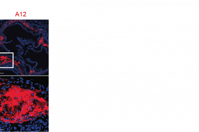 Staining with the A12 antibody (red) in an atherosclerotic plaque