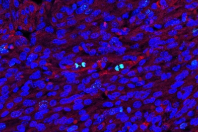 DNA bridges in mitotic cardiomyocytes. Blue: DAPI; Green: phosphoHistone 3 ( mitotic marker); Red. TnT (cardiomyocyte marker).