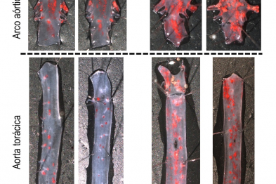 Increased atherosclerosis (red) in the aortas of progeroid mice. 