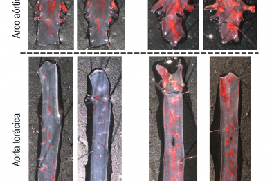 Incremento en la cantidad de aterosclerosis (rojo) en aortas de ratones progéricos.