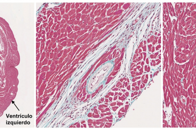 Infarto de miocardio (azul) y aterosclerosis coronaria en ratón progérico.