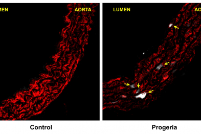 Activación de la vía de estrés del retículo endoplasmático en células de músculo liso de aorta de ratones progéricos. En rojo se muestran las células de musculo liso vascular. Las flechas indican células que expresan el marcador del estrés de retículo endoplasmático BiP (señal blanca).