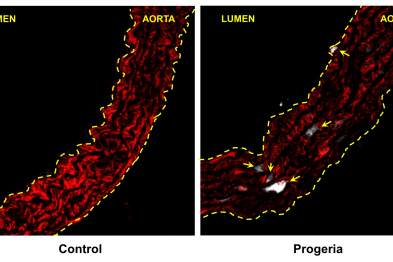 Figure 1: Activation of endothelium reticulum stress in smooth muscle cells (red) in the aorta of a progeroid mouse. Arrows indicate cells expressing the ER stress marker BiP (white).