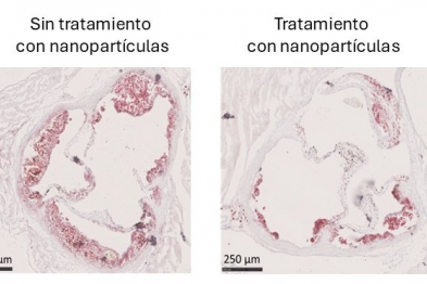 Imagen histológica de válvulas aórticas en un modelo murino de aterosclerosis. La tinción en rojo (Oil Red O) revela la acumulación de lípidos. A la izquierda, una válvula aortica de un ratón no tratado muestra una extensa lesión aterosclerótica. A la derecha, un ratón tratado con nanopartículas que contienen dexametasona y van dirigidas a cDC1s presenta una notable reducción de lípidos y menor desarrollo de la lesión. Estas nanopartículas permiten una modulación específica del sistema inmunitario, reducien