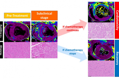  Magnetic resonance images (T2 mapping) and corresponding histological analysis in animals treated with anthracyclines. The subclinical phase is characterized by T2 mapping alterations caused by edema in the cardiomyocytes (evident as vacuoles in the histology images).