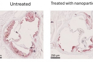 Histological image of aortic valves in a mouse model of atherosclerosis. Red staining (Oil Red O) highlights lipid accumulation. On the left, the aortic valve of an untreated mouse shows an extensive atherosclerotic lesion. On the right, a mouse treated with dexamethasone-loaded nanoparticles targeting cDC1s shows marked lipid reduction and less lesion development. These nanoparticles enable targeted immune modulation, reducing the inflammation associated with atherosclerosis progression.