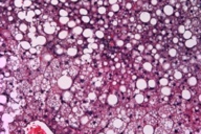 Image of fatty liver