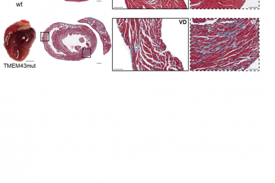 Expression in mouse hearts of the human TMEM43 protein carrying the p.S358L mutation causes cardiac fibrosis and dilation. Upper panels show images of control hearts from wild-type (wt) mice. Lower panels show images of hearts from mice expressing the mutant TMEM43 protein (TMEM43mut). 