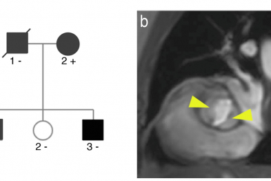 Mutations in the MIB1 gene are associated with the development of a bicuspid aortic valve. (a) Family tree in which the parents (I) have bicuspid aortic valve and the mother (2+) carries the MIB1V943F mutation. The male children have bicuspid aortic valve and one of them carries the MIB1V943F mutation (1+). (b) Magnetic resonance image of a bicuspid aortic valve (arrowheads).