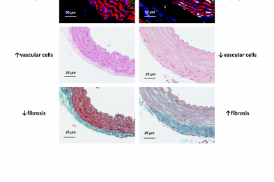 Aortas from a healthy mouse (left) and an HGPSrev mouse with progeria. As occurs in HGPS patients, the cells of the HGPSrev aorta express progerin (white nuclei), and the aorta shows evidence of vascular smooth muscle cell loss (blue nuclei) and prominent vascular fibrosis (green signal).