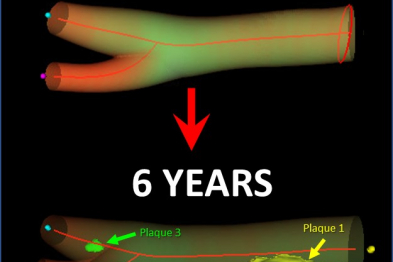 reconstrucción de estudio de ecografía vascular en carótidas de un sujeto aparentemente sano del estudio PESA-CNIC-Santander. La imagen superior corresponde a la imagen en el primer estudio de imagen donde no se objetiva ninguna placa de aterosclerosis. La imagen inferior corresponde a la misma arteria carótida 6 años después de la primera. Se observa cómo han aparecido nuevas placas de ateroma. 