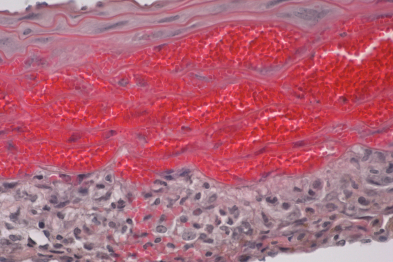 Imagen microscópica de hematoma intramural en el modelo preclínico de la enfermedad. Se muestra la acumulación de la sangre invadiendo la capa media de la aorta.