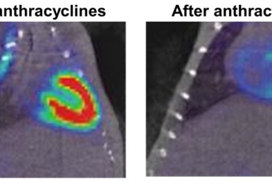 Effect of anthracycline treatment on cardiac metabolism. The image on the left shows the heart of an untreated mouse. The red zone, with its green halo, indicates uptake of fatty acids and glucose as energy sources (normal cardiac metabolism). The image on the right shows the heart of the same mouse after several doses of anthracyclines. The muted blue signal indicates strongly reduced uptake of these substrates.  