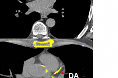 Calcium deposits (white) in the coronary arteries.