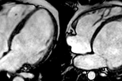 Cardiac magnetic resonance images of two patients with dilated cardiomyopathy without left ventricular hypertrabeculation (left) and with left ventricular hypertrabeculation (right).