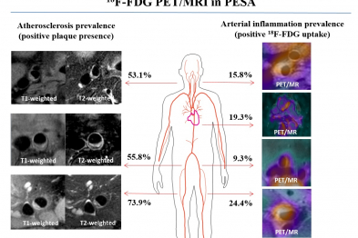 Prevalence of atherosclerosis and arterial inflammation detected in different vascular territories by PET/MRI detection of the radiotracer 18F-FDG in PESA study participants. 18F-FDG, radiolabeled fluordeoxyglucose; PET/MRI, positron emission tomography and magnetic resonance imaging. 
