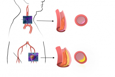 Relationship between plaque characteristics and the presence of inflammation. Plaques with inflammation (positive for 18F-FDG uptake) are more prevalent in the iliofemoral territory (at the bifurcation), tend to be larger, show positive remodeling (growth away from the vessel lumen), and contain larger cholesterol deposits (yellow). Plaques with no inflammation tend to be smaller and lack positive remodeling. 