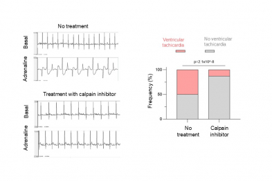 Calpain inhibition reduces ventricular arrhythmias. Representative ECG recordings from mice with CPVT, untreated or treated with a calpain inhibitor, after administration of adrenaline to trigger arrhythmias (left). Treatment reduced the proportion of animals that developed sustained ventricular tachycardia (right).