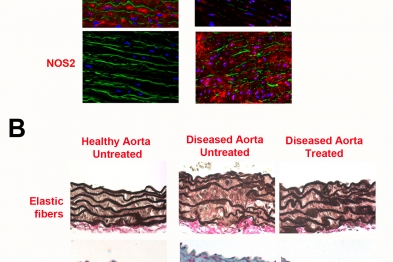 Inhibition of the protein NOS2 has therapeutic potential in Marfan syndrome  (A) Comparison of the expression of ADAMTS1 and NOS2 proteins (both in red) and elastic fibers (green) in the aortic wall of a healthy donor and a Marfan syndrome patient. (B) Staining showing elastic fiber organization (dark brown) and collagen deposits (blue) in the aortic wall of a healthy mouse (Healthy Aorta Untreated), a mouse with untreated syndromic aortic disease (Diseased Aorta Untreated), and a diseased mouse treated wit