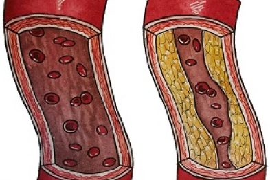 A healthy artery (left) and an artery affected by atherosclerosis (right).