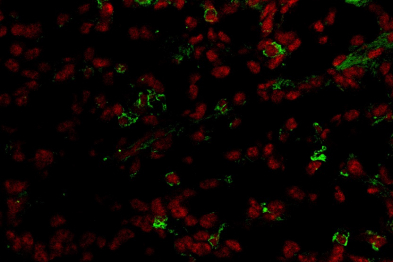 Inmunofluorescencia que muestra una sección de un tumor de ovario, donde se observa la presencia de macrófagos peritoneales que han infiltrado el tumor (células con un núcleo rojo rodeado de citoplasma verde).